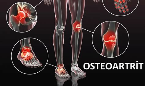 osteoartritte sistemlerde ağrı